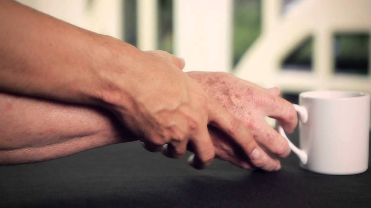 Pozzilli, Neuromed: dalla saliva la possibilità di un test per la diagnosi della malattia di Parkinson