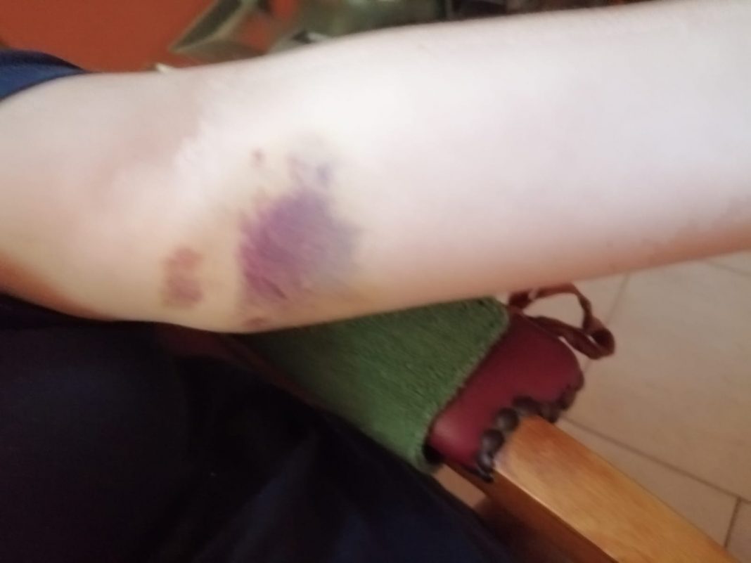 L’odissea di Rachele: ricoverata per occlusione e dimessa senza trattamento