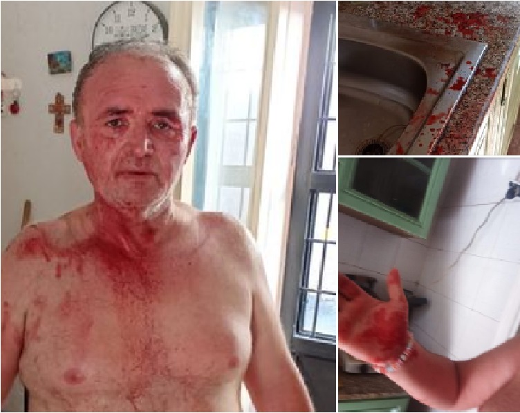 Acerra, assalto ai vicini per il posto auto: padre e figlio feriti a sprangate