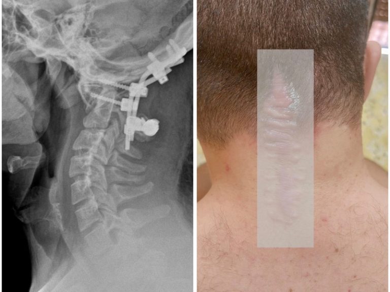 Ragazzo disabile segregato in casa per mancata installazione dell’ascensore